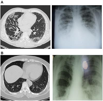 Case Report: Hyperbilirubinemia in Gilbert Syndrome Attenuates Covid-19-Induced Metabolic Disturbances
